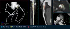 Coronary artery CT shows calcified, non-calcified, and lipid-rich necrotic plaque sections, with color coding.