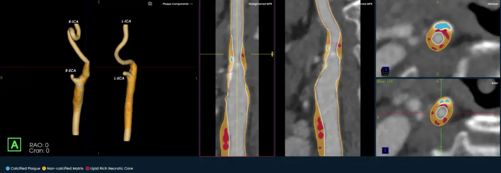 3D and cross-sectional CT angiogram views showing carotid artery with highlighted plaque and vessel narrowing.