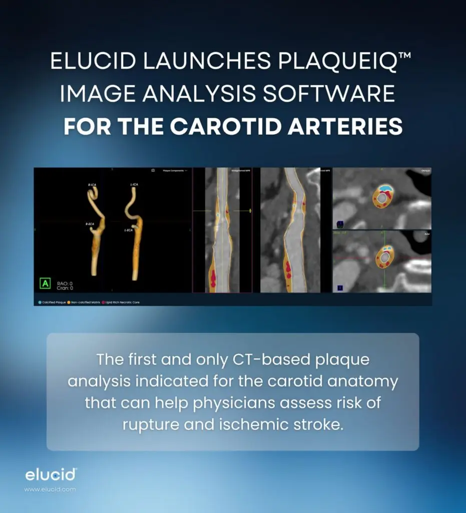 Medical software ad showing artery scans and text about ELUCID’s new CT-based plaque analysis for carotid arteries.