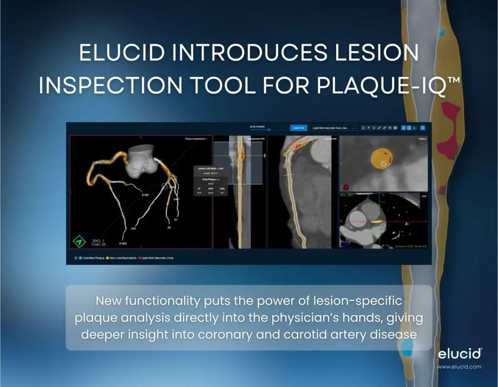 Computer screen showing Elucids lesion inspection tool for artery plaque analysis, with medical images displayed.