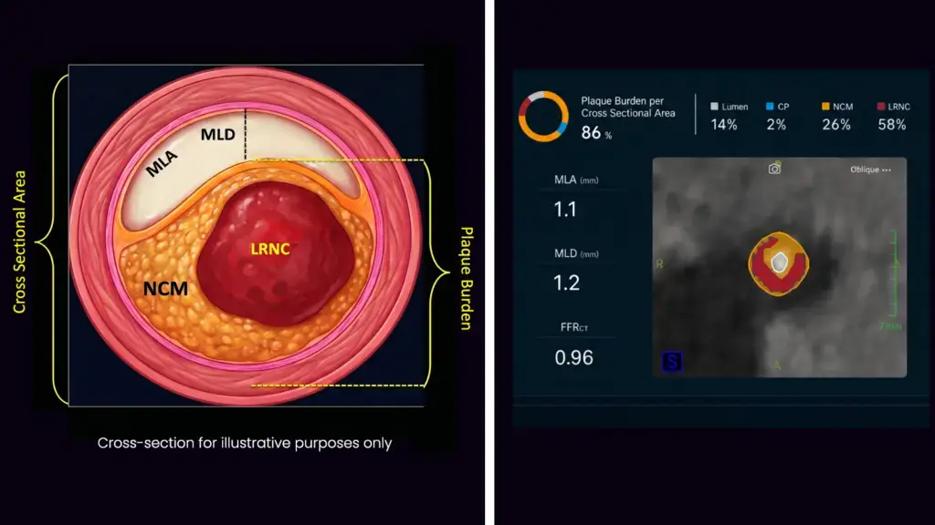 Medical diagram of a blood vessel cross-section and an analysis chart showing plaque and vessel measurements.