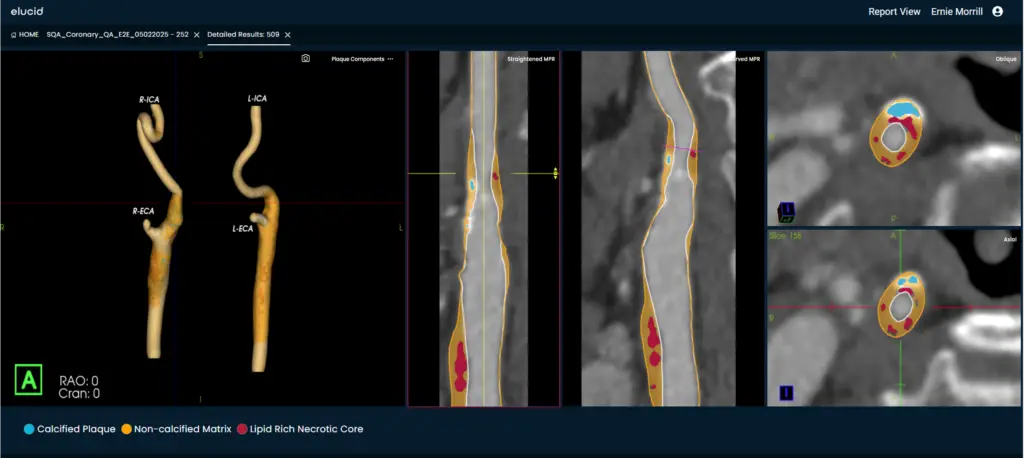 3D and cross-sectional artery scans show plaque buildup in yellow, red, and blue along vessel walls.