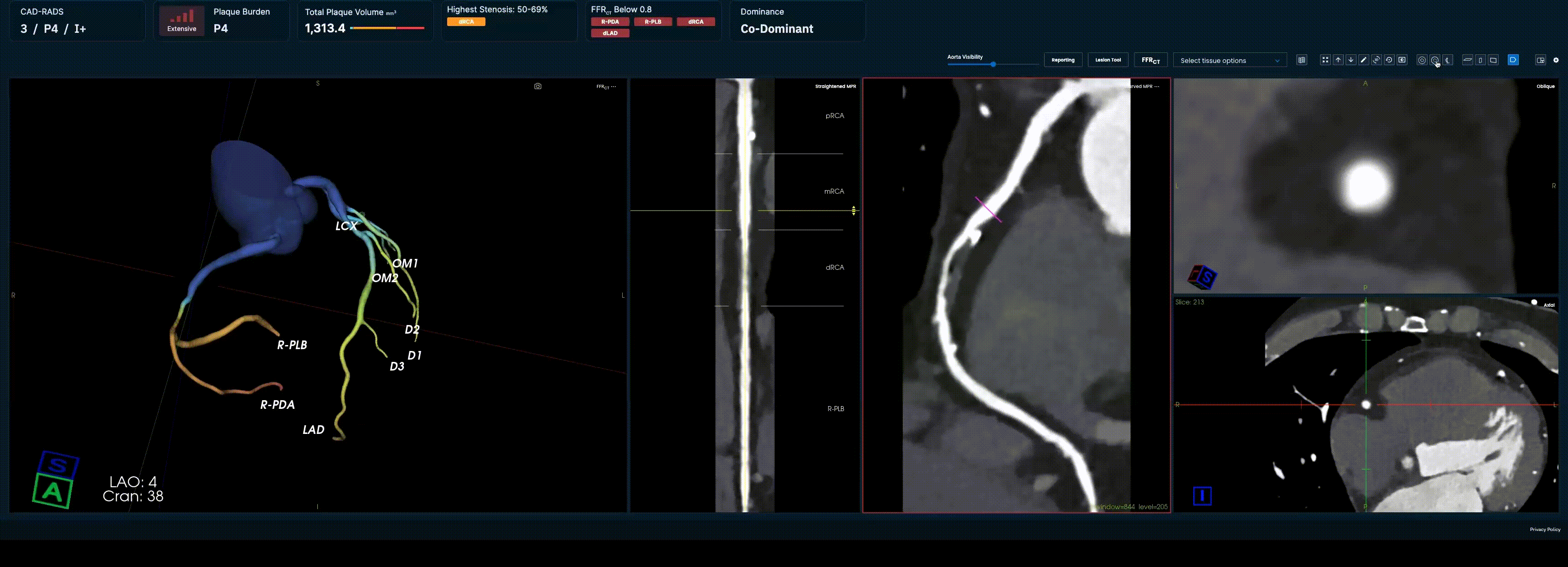 Medical imaging scan showing coronary artery segments and cross-sectional views of a heart and blood vessels.