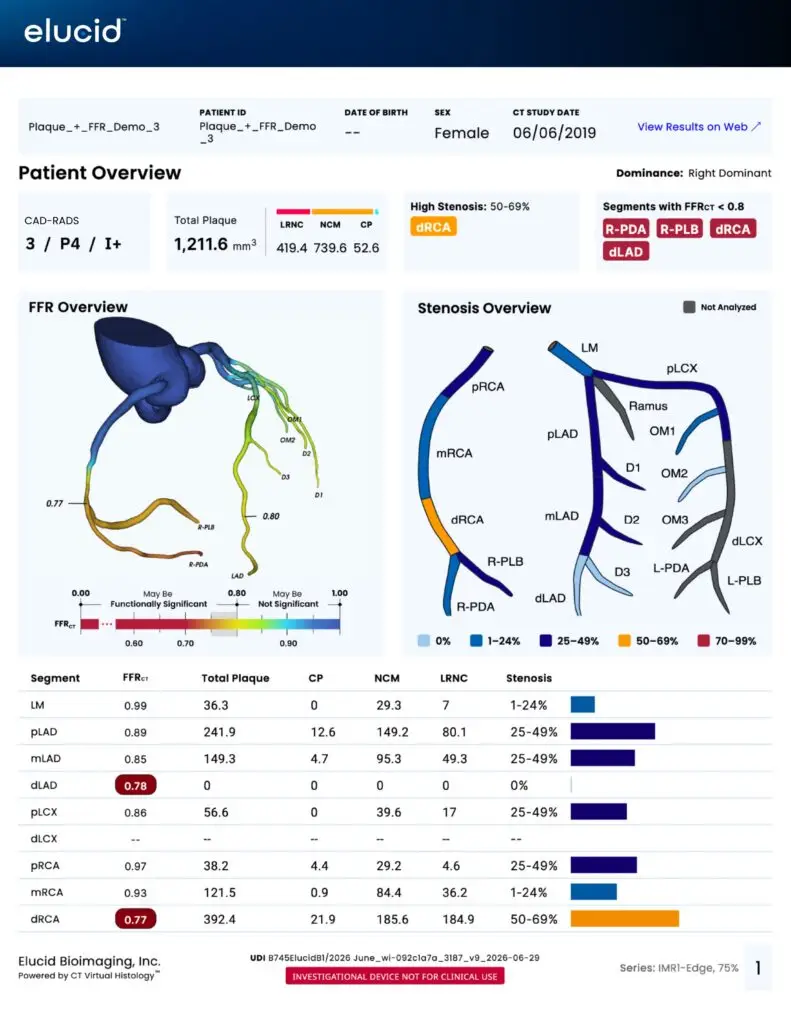 Medical report showing heart artery diagrams, plaque scores, and colored graphs displaying blockage percentages.