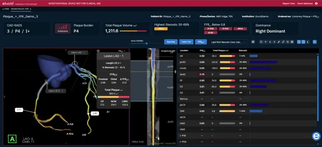 Medical dashboard showing coronary artery analysis, lesion details, and visual graphs highlighting plaque and stenosis data.