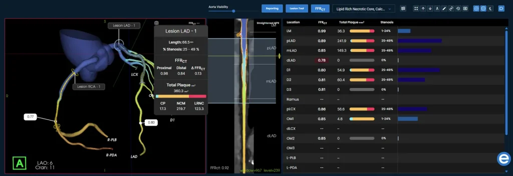 Medical dashboard showing coronary artery analysis, lesion details, and visual graphs highlighting plaque and stenosis data.