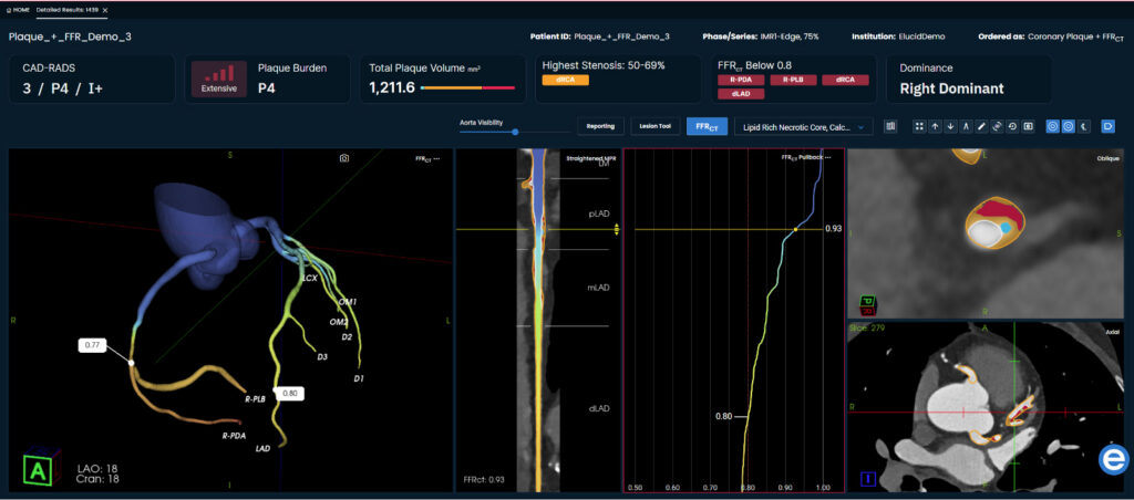 Medical imaging dashboard showing a 3D heart artery scan, charts, and cross-sectional artery images.