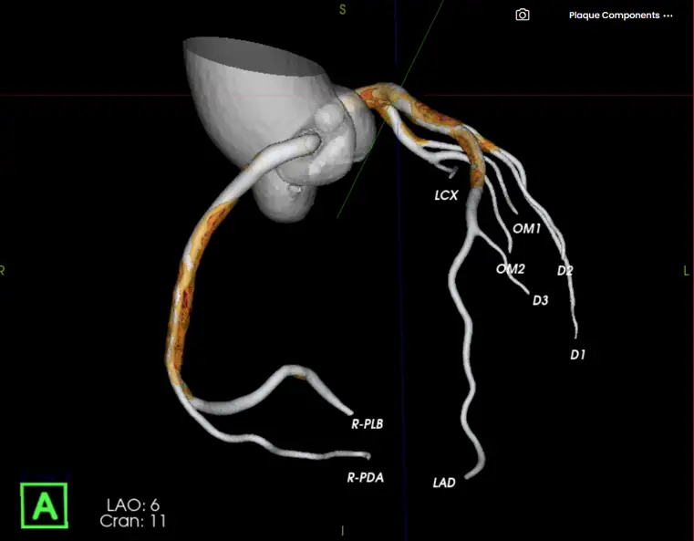 3D model of coronary arteries with labels and highlighted plaque buildup along several vessels.