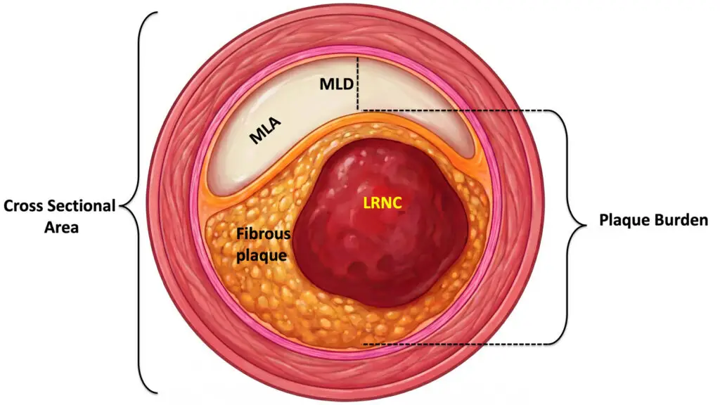 Cross-section of an artery showing fibrous plaque, LRNC, MLA, MLD, and labeled plaque burden.