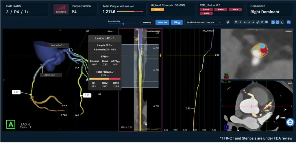 Medical dashboard showing coronary artery analysis, lesion details, plaque burden, and CT scan cross-sections.