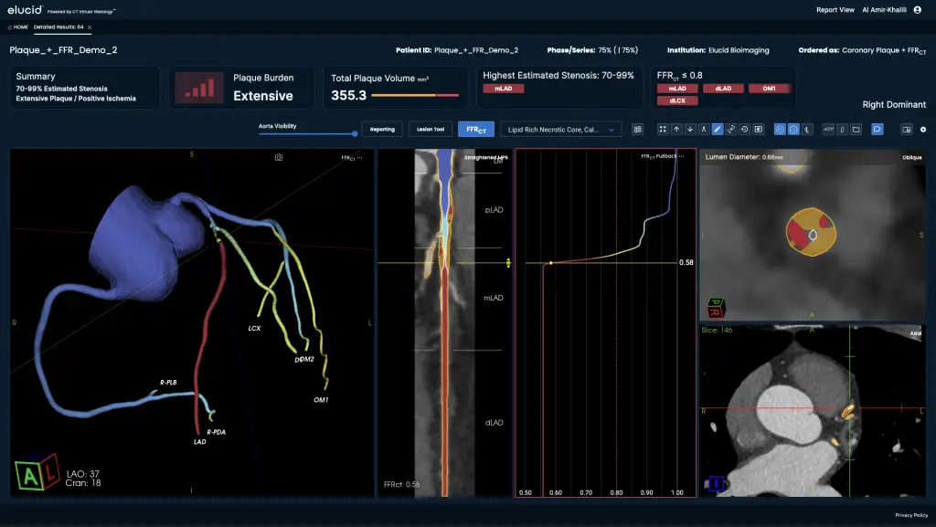 Medical imaging dashboard showing coronary artery analysis, plaque burden graphs, and vessel cross-sections.