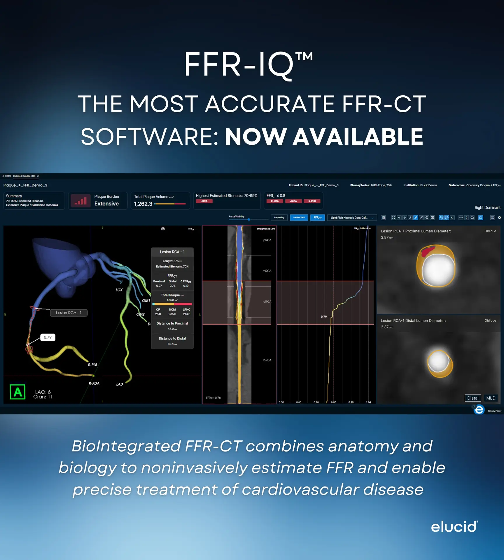 Marketing graphic for FFR-IQ software showing a patients coronary artery analysis dashboard and scan results.