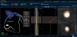 Medical software dashboard showing a 3D coronary artery model, arterial cross-sections, and FFRct analysis metrics.